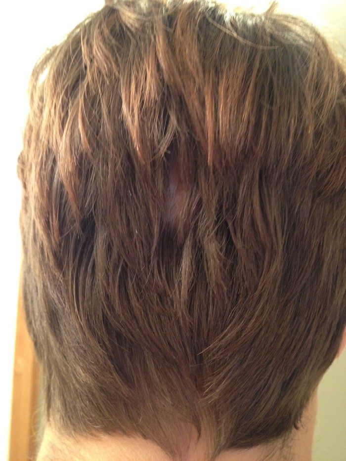 3 months post op scar is almost hidden by hair