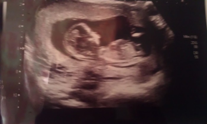 Our little bean is starting to look like a little baby :)