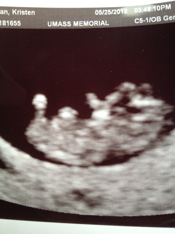 Baby C at 10 weeks!