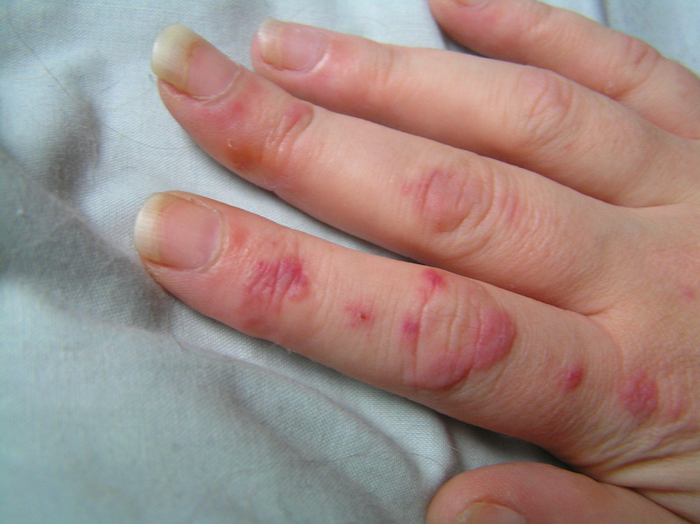 Hand rash with blood blisters