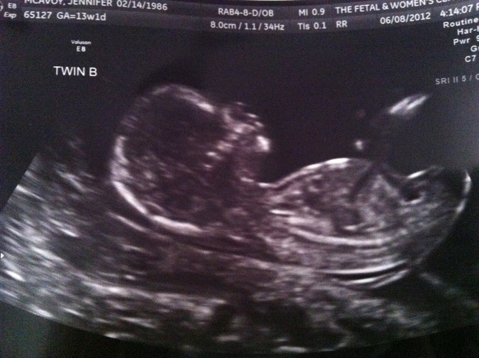 And our petite little girl at 13 weeks! Don't they have the cutest profiles ;)