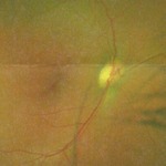 My Right Eye Optic Nerve Disc