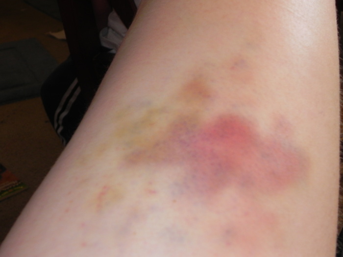 Another Pic of Largest Bruise Showing the Multiple Colors