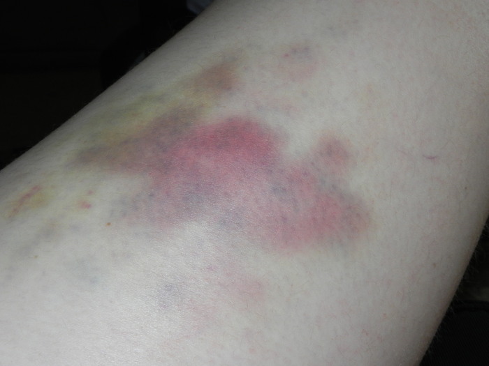 Can you see the tiny purple dots in the middle of the bruise?
