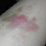 Can you see the tiny purple dots in the middle of the bruise?
