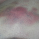 Same Bruise Outer Left Thigh