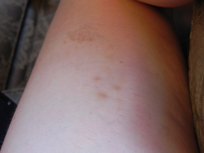 Outer Right Thigh (tiny old bruises and cluster of brown dots)