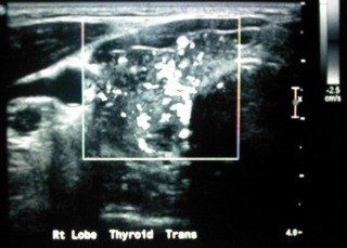 Rt Lobe Thyroid Trans