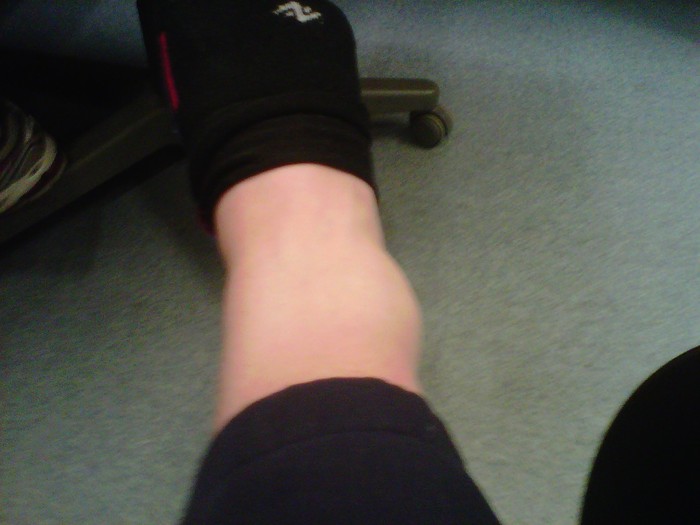 ankle after I fell