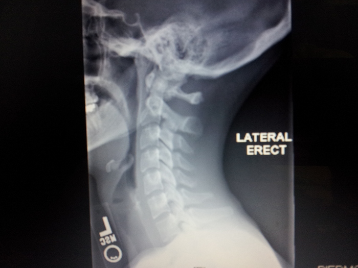 Head straight from the side (X-ray)