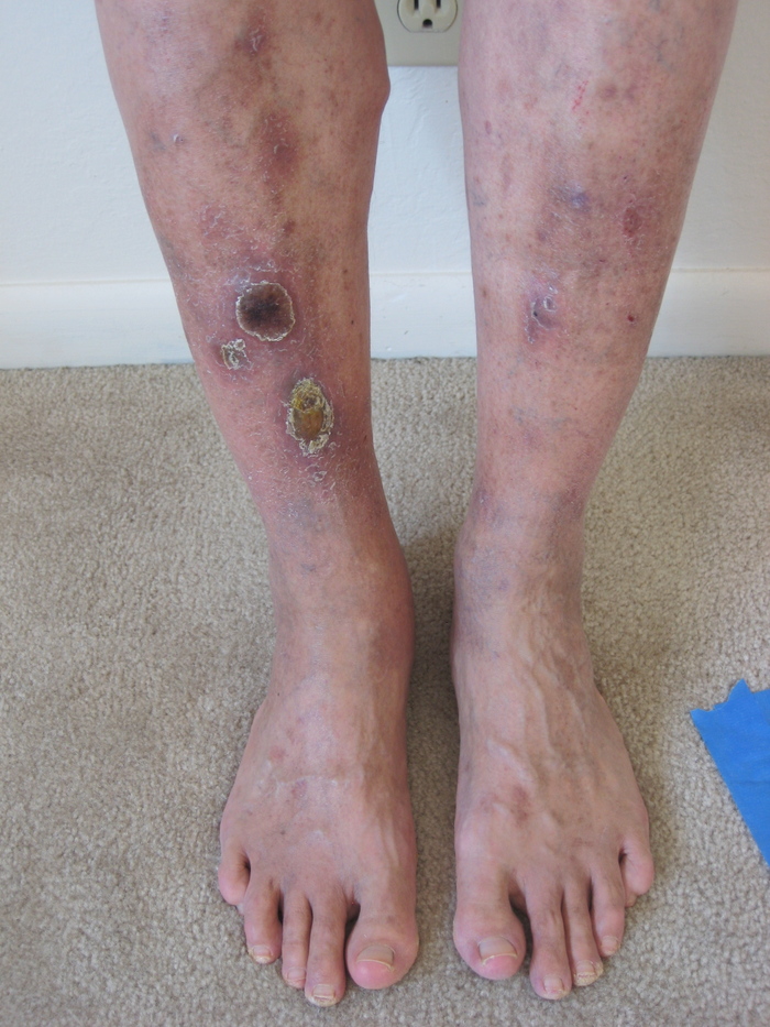 03/20/2012 Week 24  Stasis Dermatitis