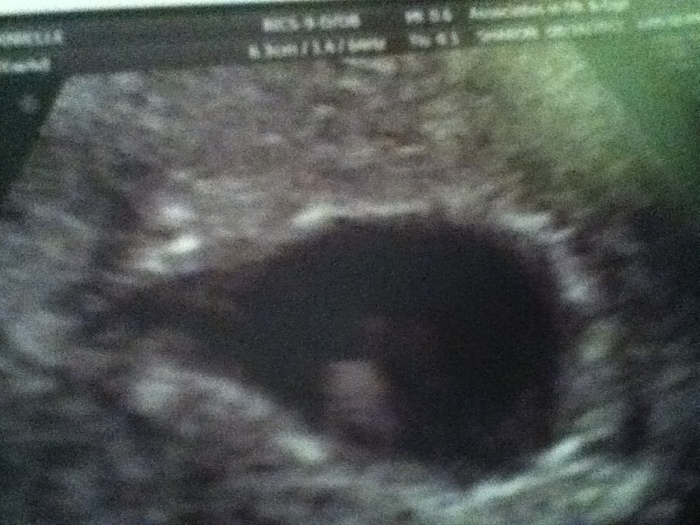 Our baby at 6 wks 4 days.