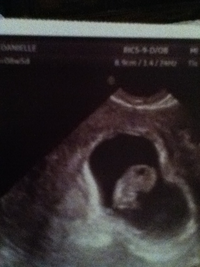 OUR BABY AT 8WKS 5DAYS. HR 180