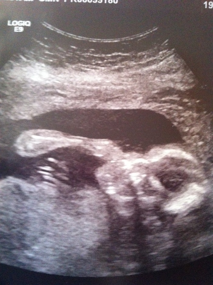 20w Ultrasound.  Baby Ryan is sucking his fist!!