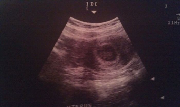 My little embryo.