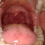 Myt  Sore Throat (Pharyngitis)