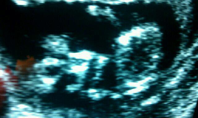 Ultrasound at 15 weeks