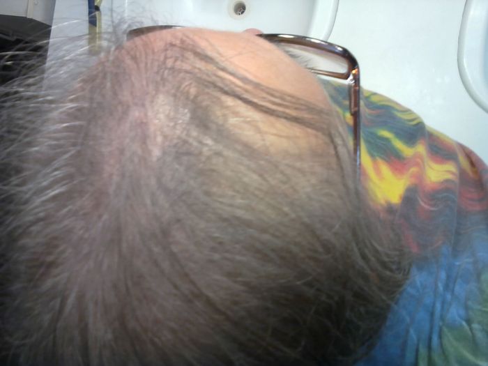 I have bald spots and very thin hair now. Texture is dry and brittle! Week 17 10-14-12