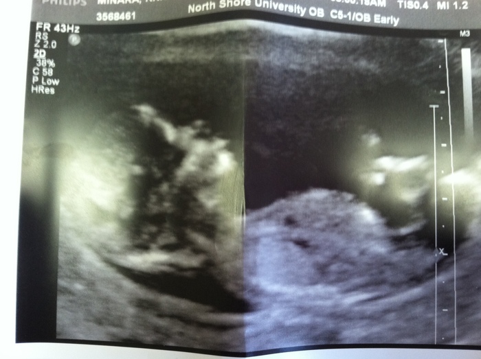 Our baby, wk 12.5