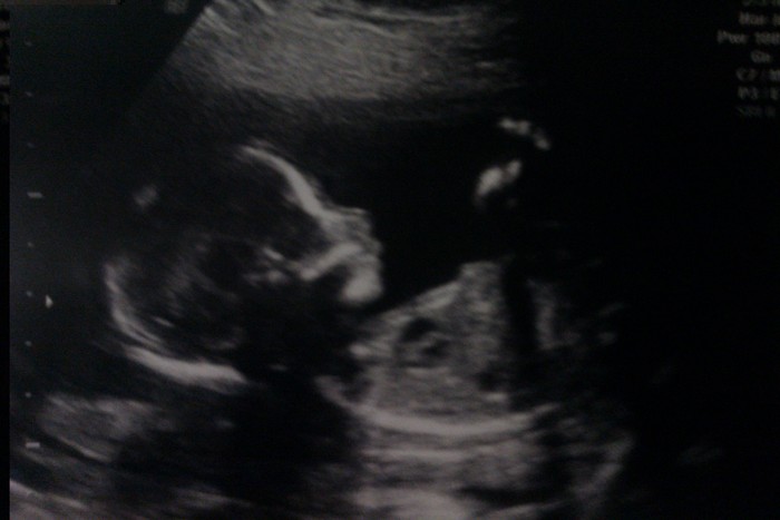 My baby girl at 18w2d! <3