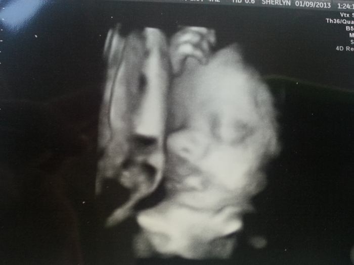 baby girl 29 weeks 3 days with umbilical cord on her mouth