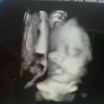 baby girl 29 weeks 3 days with umbilical cord on her mouth