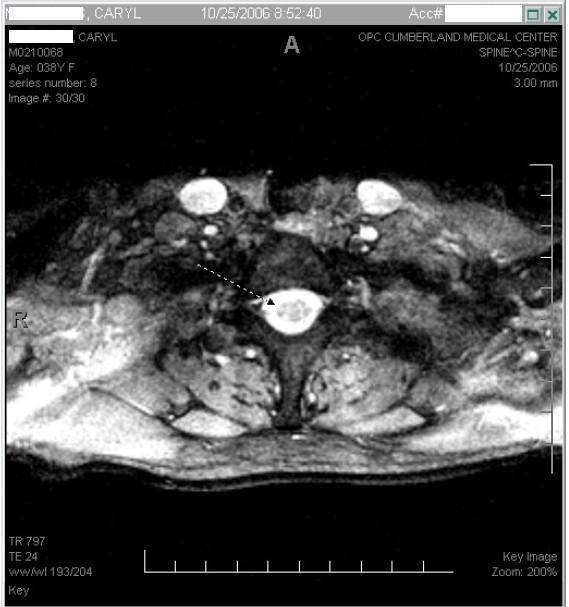 MRI of spine - lesions or not