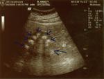 Ultrasound of stone pockets in my left kidney