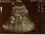 Ultrasound of stone pockets in my right kidney 