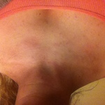 My neck before the Dep-Medrol shot. It looks swollen to me? 
