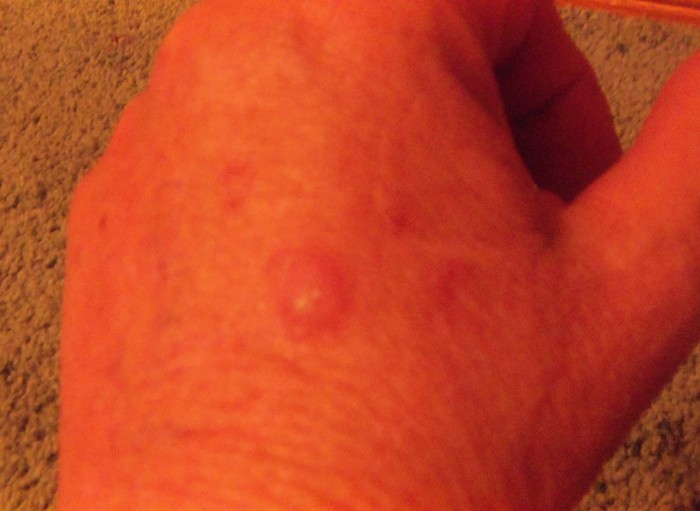 squamous cell carcinoma on my hand, 2nd most common skin cancer, yet unknown to many of  public!!!