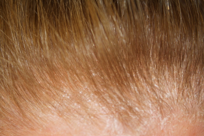 Peeling itchy scalp with hair loss starting after sensitivity came to scalp