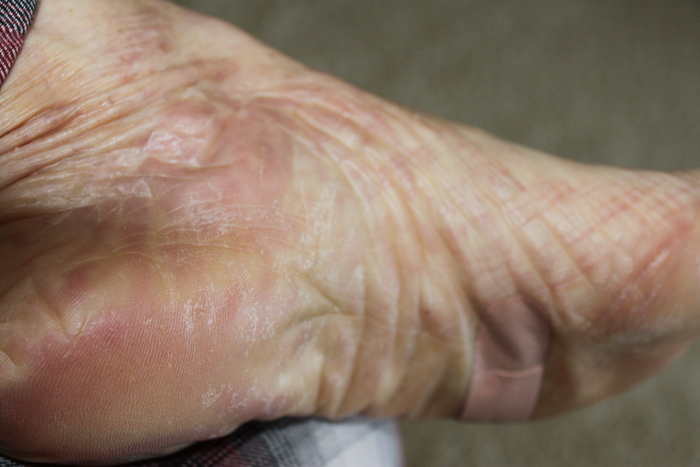 Swelling, Rash & Skin Cracking on Feet