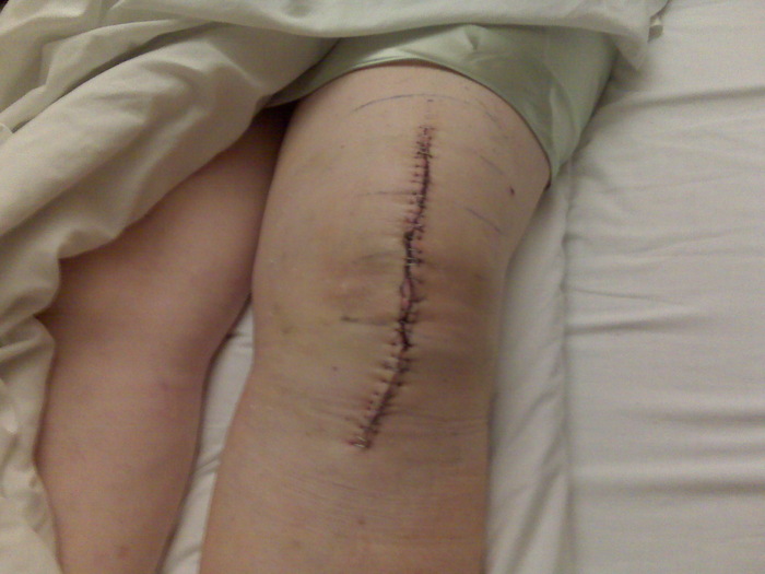 My mother's knee revision to titanium after metal allergies from nickel, cobalt and chromium.