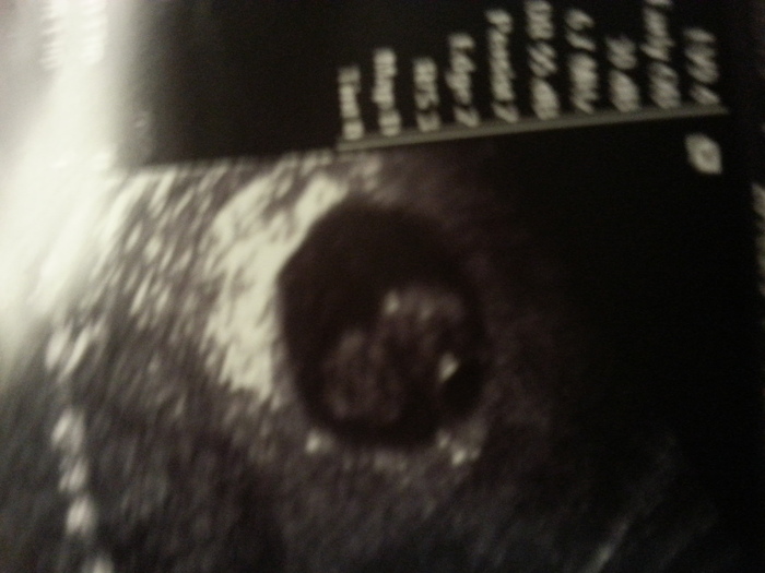 another pic from the ultrasound