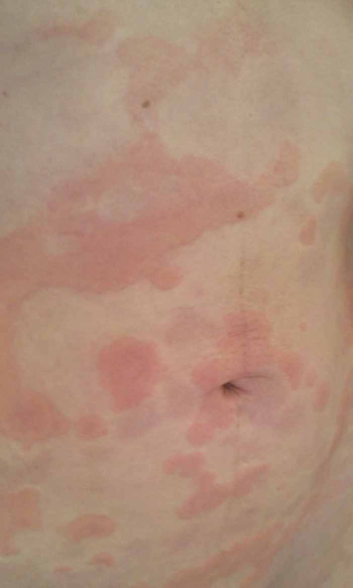 Hives and Strep, Abdomen - Day 6
