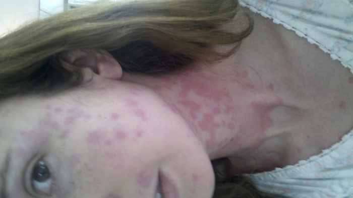 Strep and Hives