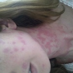Strep and Hives