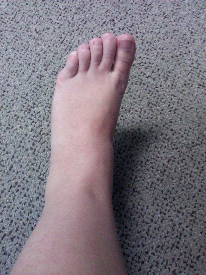 my swollen foot
