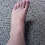 my swollen foot