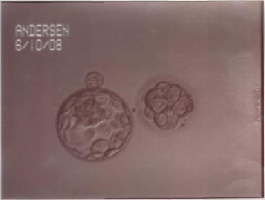 Embryos-Day 5 hatching Blastocyst-Grade A and Day 5 Morula, falling a bit behind-Grade B-bfp TWINS!
