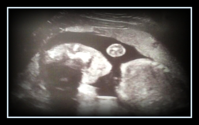 ♥ 21 weeks - He has his lil' mouth open ♥
