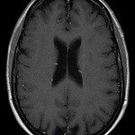 MRI with contrast