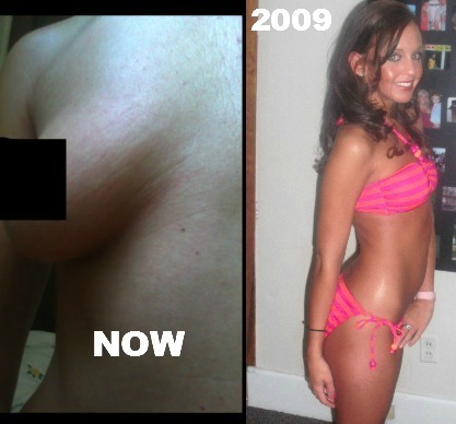 On the right before I got bit u can seen my skin is tight, firm in '09. Now its like the left, AGED 