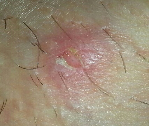 Is this herpes?