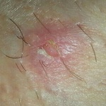 Is this herpes?