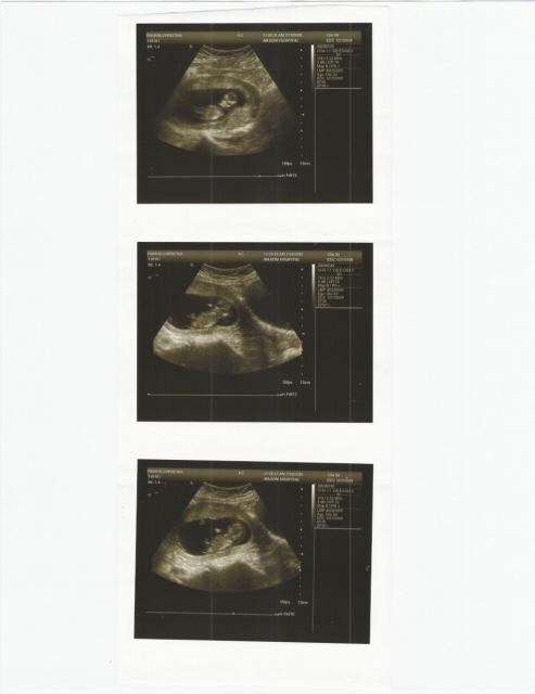 my ultrasound of my precious Corine... 15 week loss