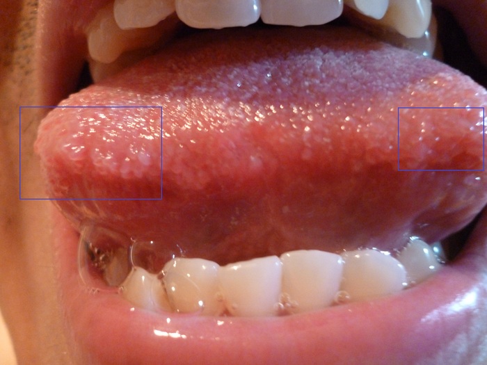 Tongue: Swollen tastebuds. December 2012
