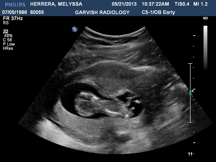 12 week ultrasound :)