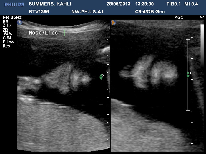 His nose and lips - 20 weeks, 4 days